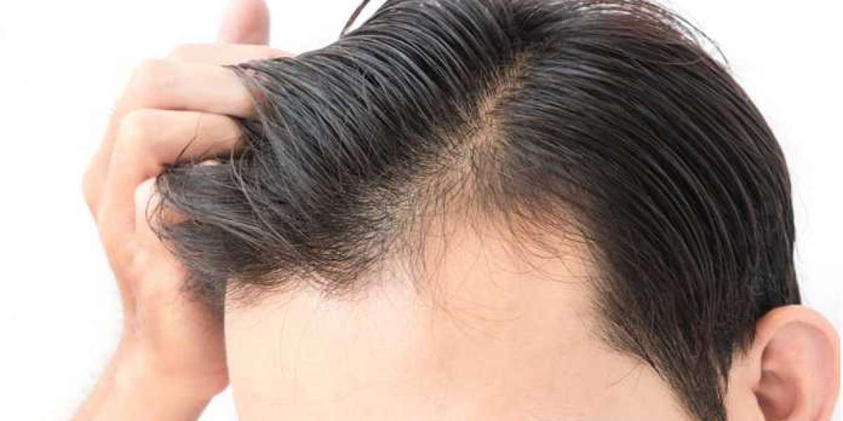 Best Hair Transplant In Delhi