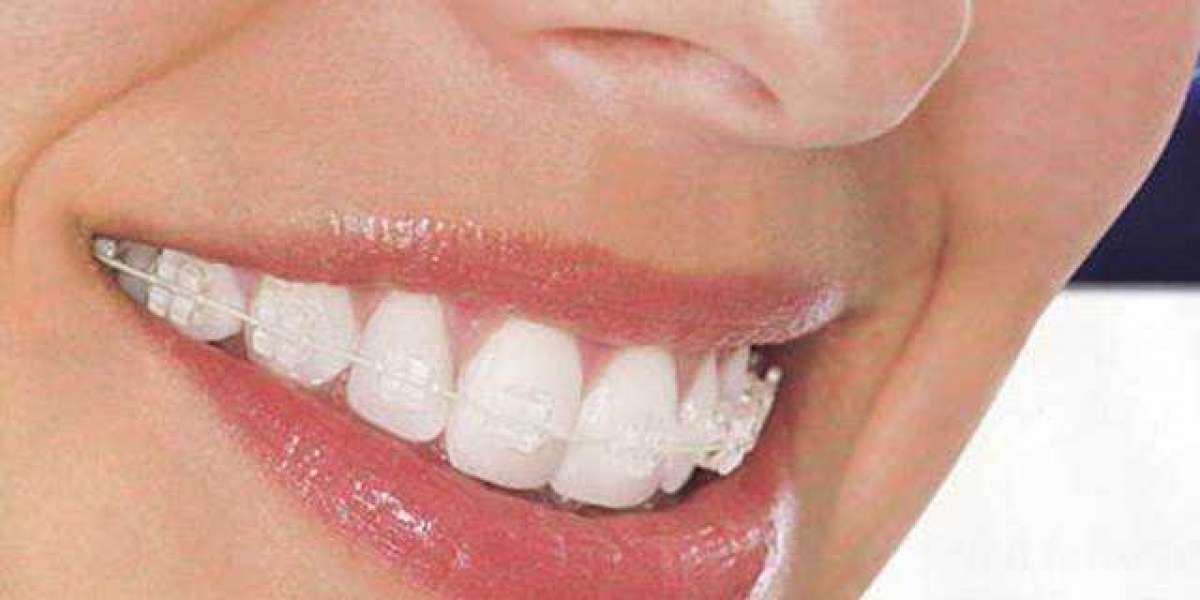 Discover The Benefits of Clear Braces- The Solution for Straightening Teeth