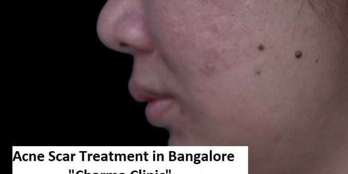 Get an Effective Treatment for Acne Scars at Charma Clinic