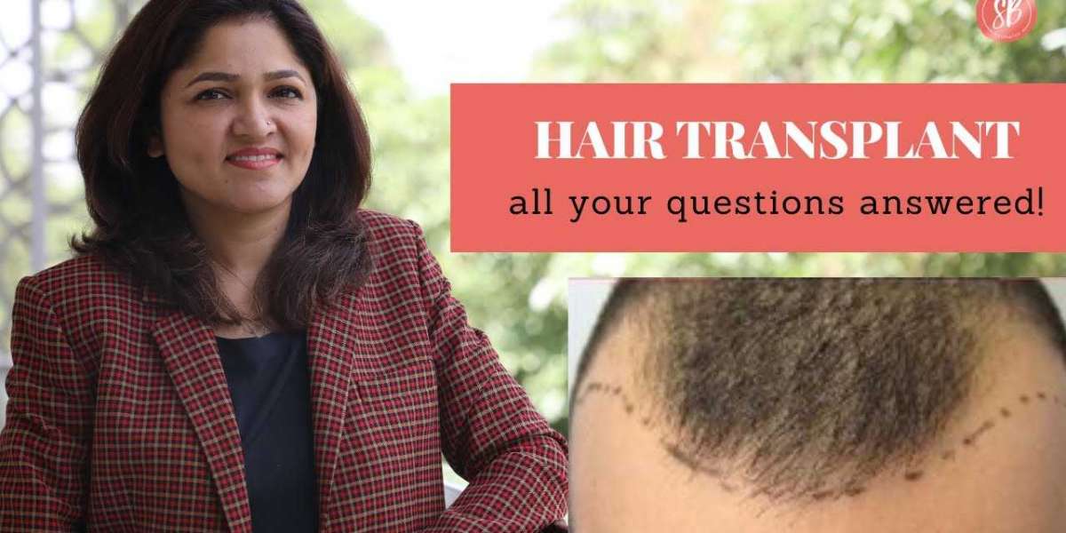 SB Aesthetics- Best Hair Transplant Clinic in Gurgaon