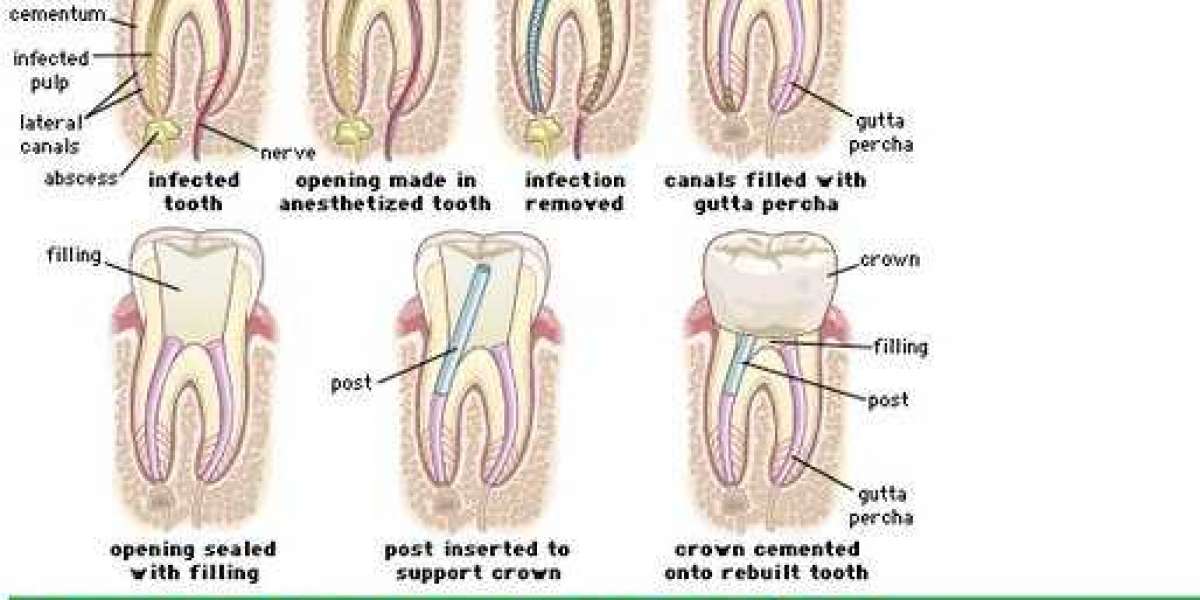 What is the RCT of your teeth?