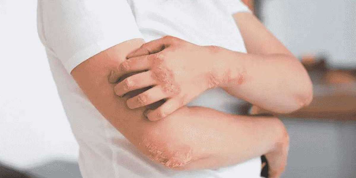 Treat fungal infection at Soul Derma Clinic in South Delhi