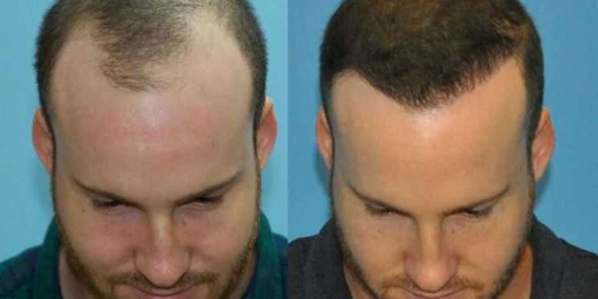 Hair Restoration Seattle