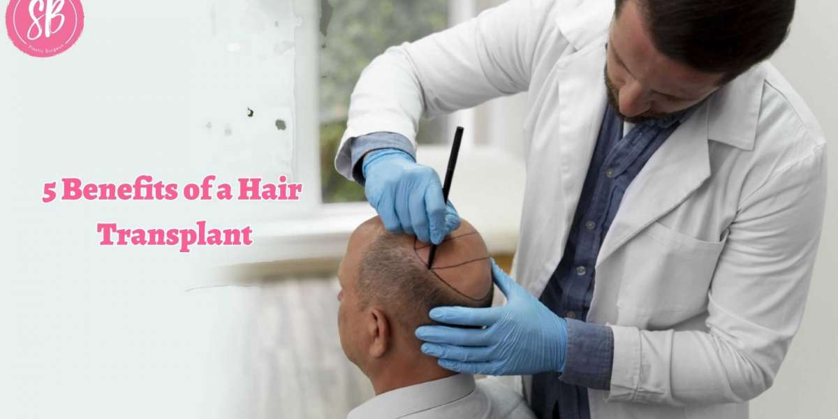5 Benefits of a Hair Transplant