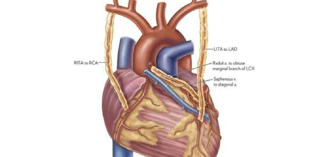 What is the Coronary Bypass Surgery Cost in Delhi?