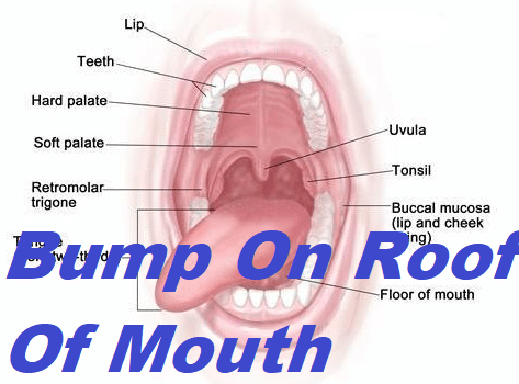 Bump On Roof Of Mouth – Grow Health