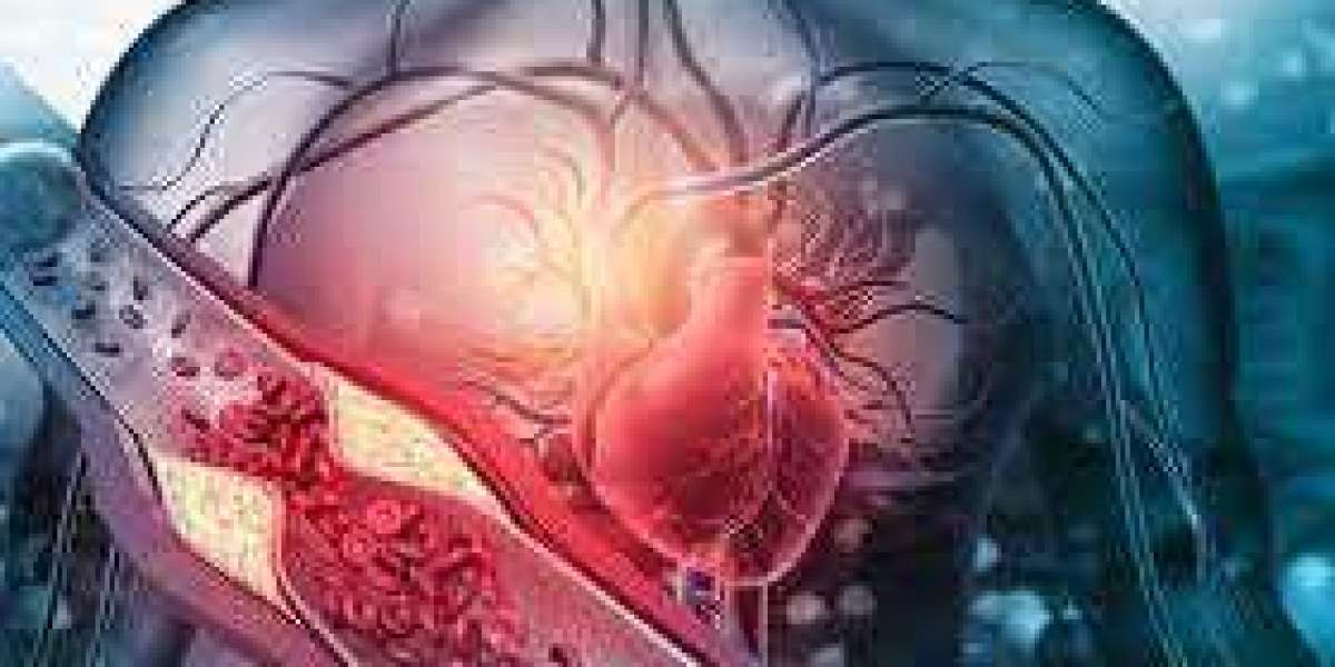Atherosclerosis Market In-Depth Summary, Growth Factors, Regional Analysis And Forecasts Outlook by 2032