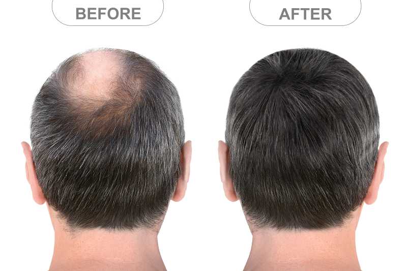 Non-Surgical Hair Transplant | Mohit Hair Affair