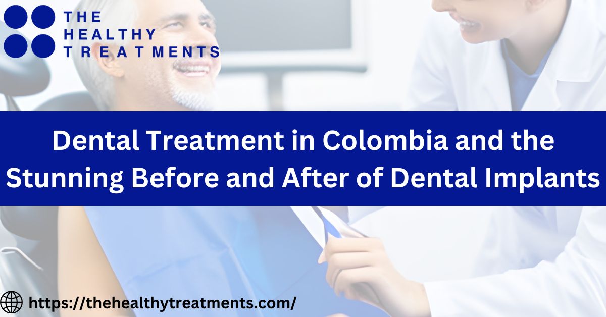 Transforming Smiles: Dental Treatment in Colombia and the Stunning Before and After of Dental Implants