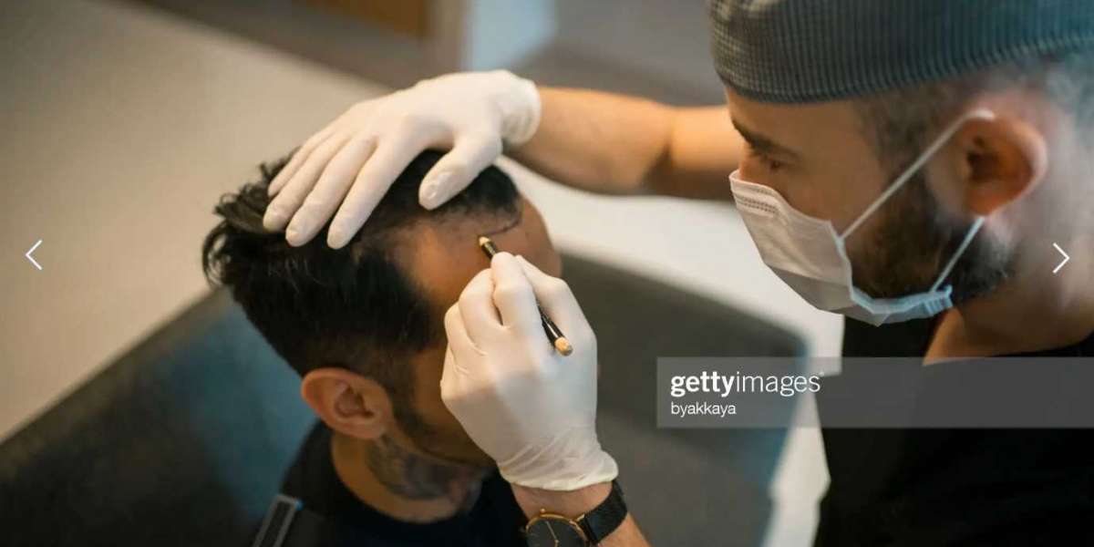 FUE Hair Transplant: Effective Solution for Hair Loss