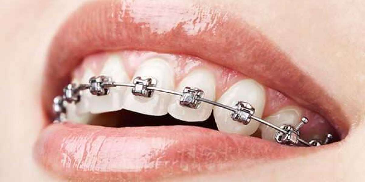 No Need to Hide Smile With These Invisible Braces