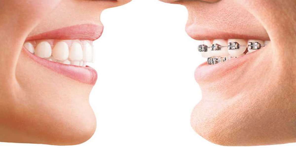 Invisalign Aligners and Invisible Braces Unveiled