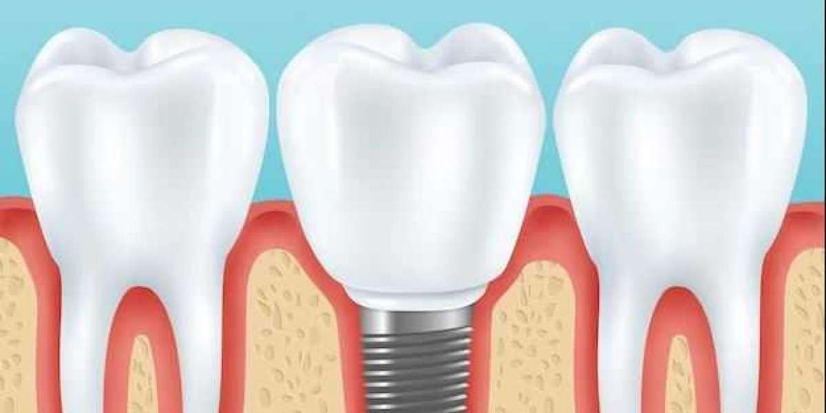 Top Rated Dentist Implant Near Me-Valley Creek Dental Care