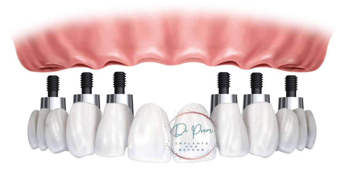 A Beautiful The Benefits of Full Mouth Dental Implants