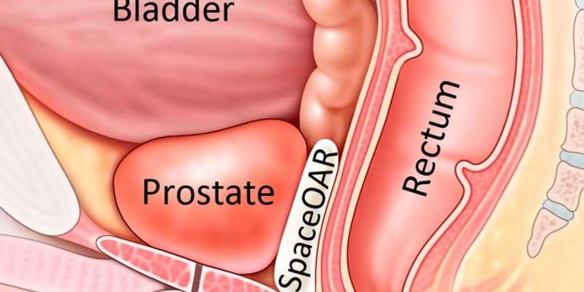 Revolutionizing Prostate Gland Treatment - PFlow