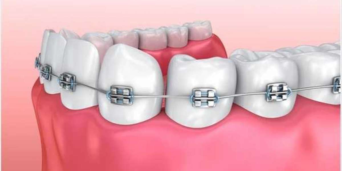 Give The Best Care to You Teeth with Best Braces Treatment