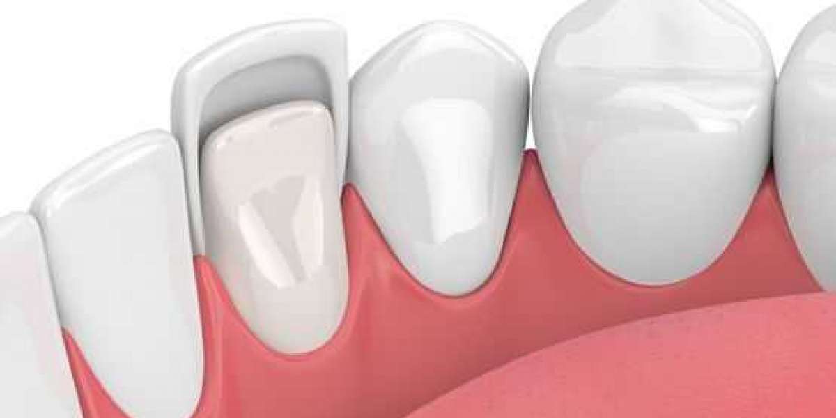 Transform Your Smile with Dental Veneers: A Comprehensive Guide