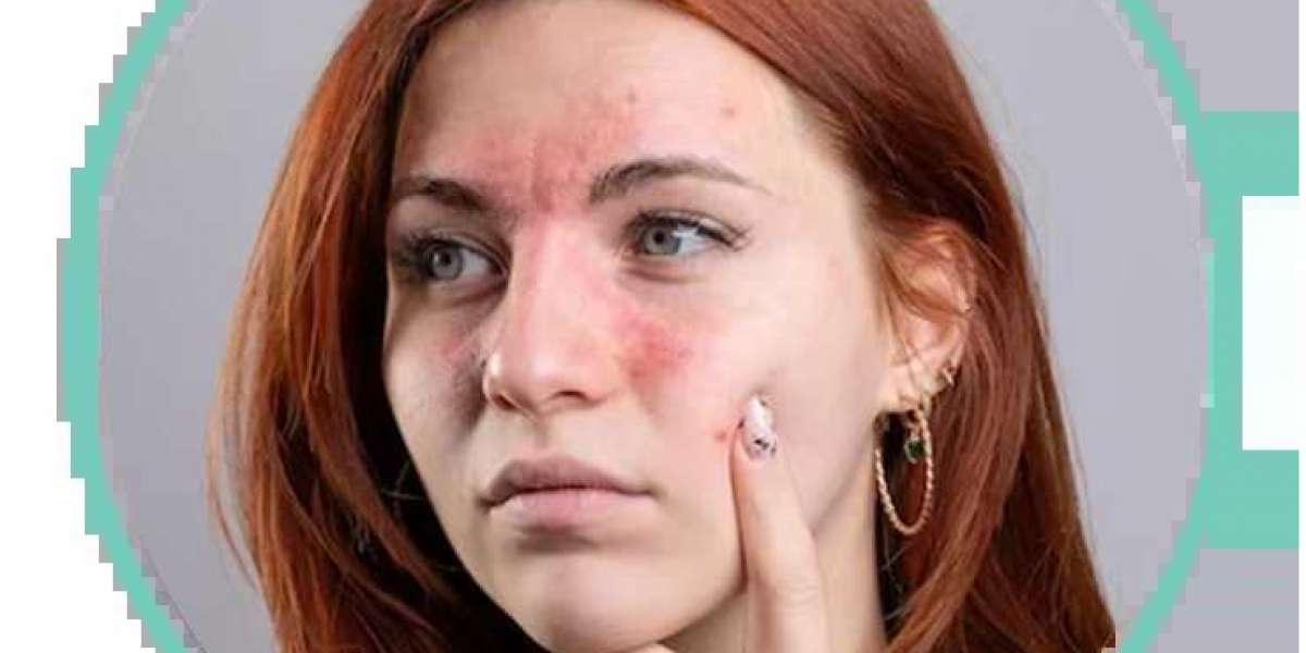 Unveiling the Lupus Face Rash: Understanding Symptoms, Triggers, and Management