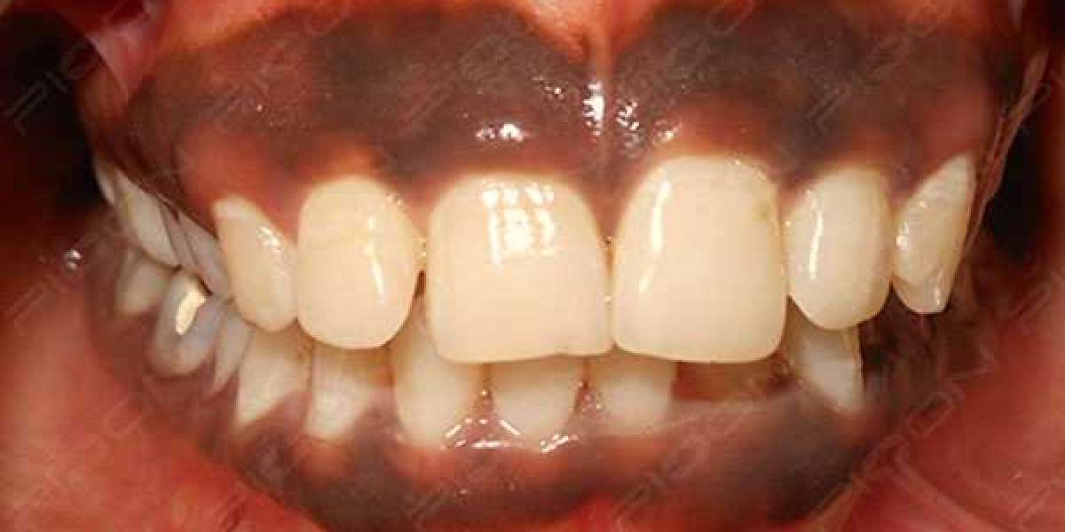 Understanding Gums Hyperpigmentation: Causes, Treatment, and Prevention