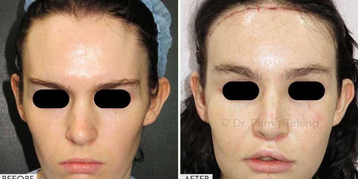 Facial Feminization Surgery Cost In USA