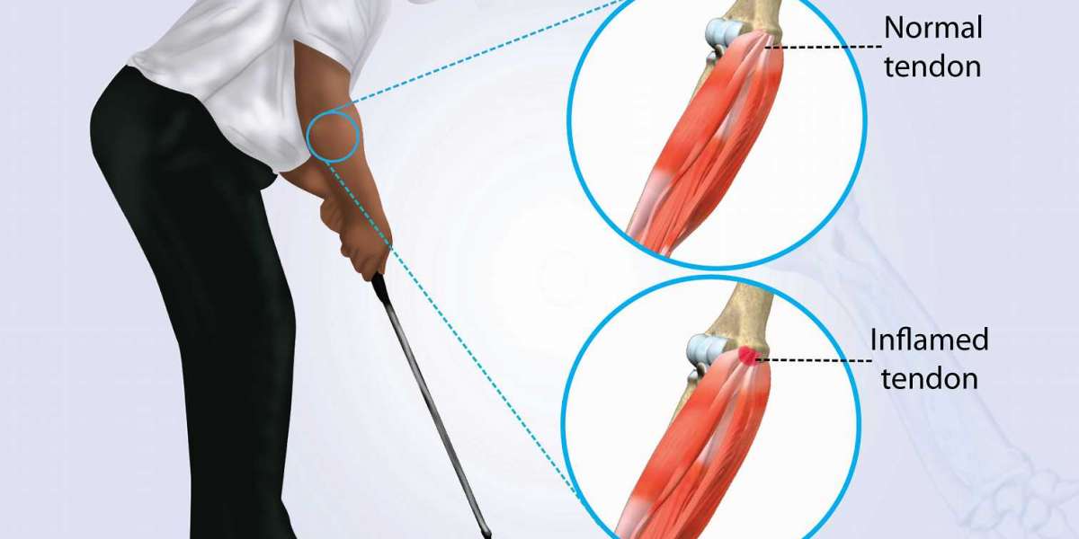 How to Treat Golfer's Elbow Pain with Aspadol 200