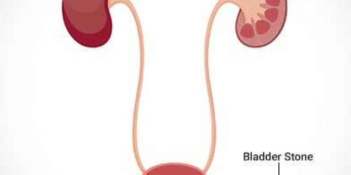 What are the 5 Warning Signs of Bladder Infection?
