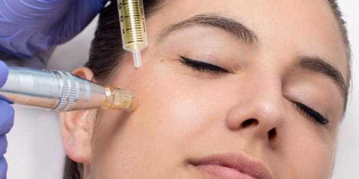 Unveiling the Transformative Power of Microneedling for Acne Scars