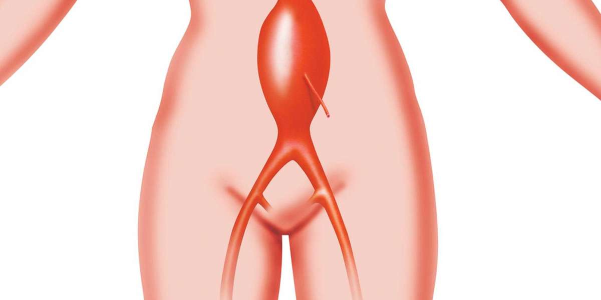 Finding Hope and Expertise: Top Hospitals for Abdominal Aortic Aneurysm Treatment in India