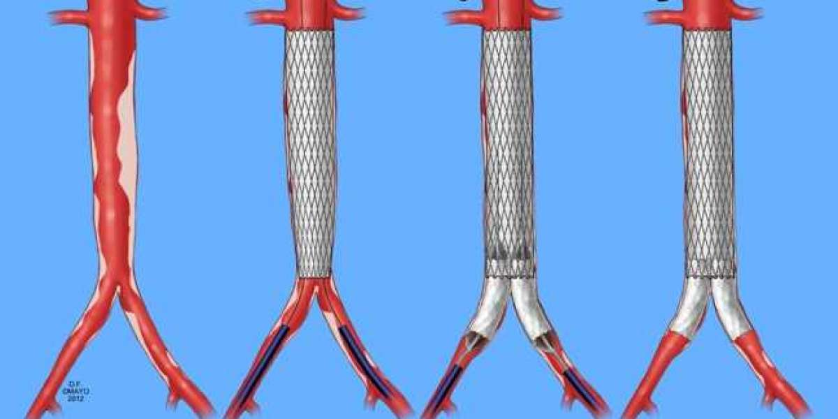 Affordable Aortic Stent Grafting: Exploring Options in India