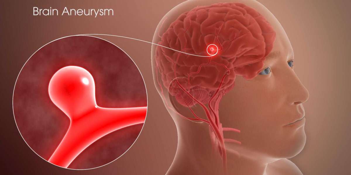 Brain Aneurysm Treatment: Your Guide to Options & Recovery