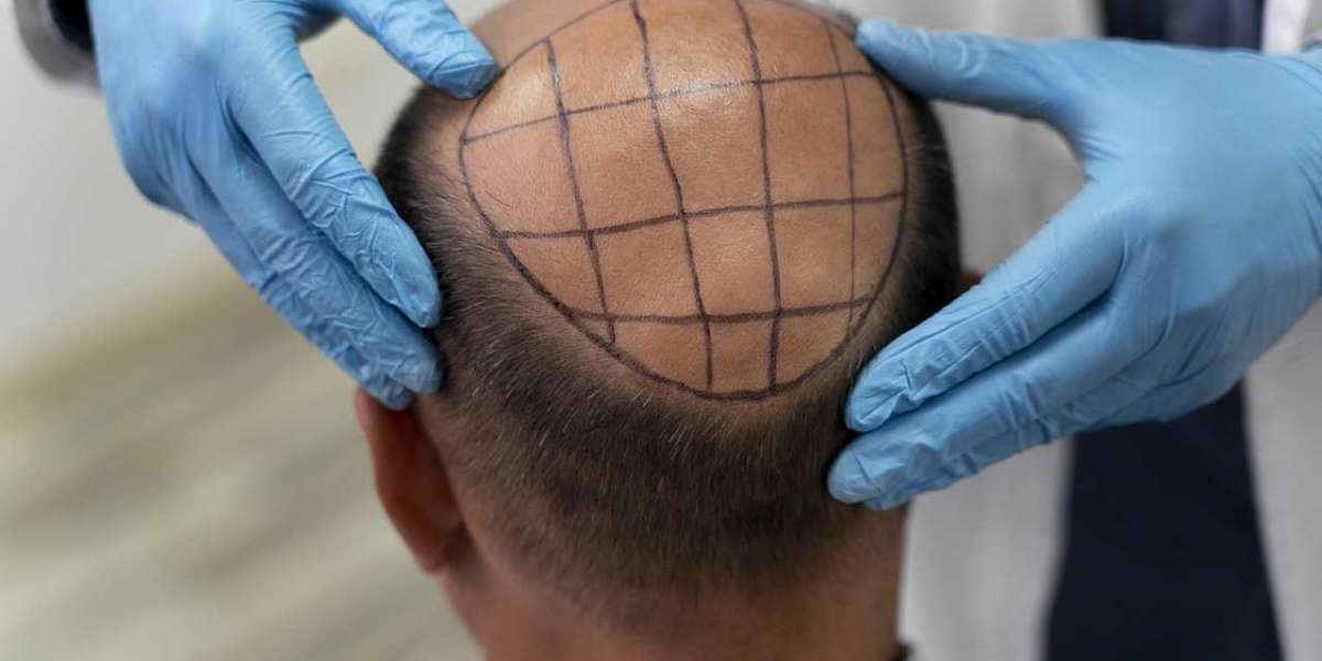 Unlocking the Potential of Follicular Unit Transplantation