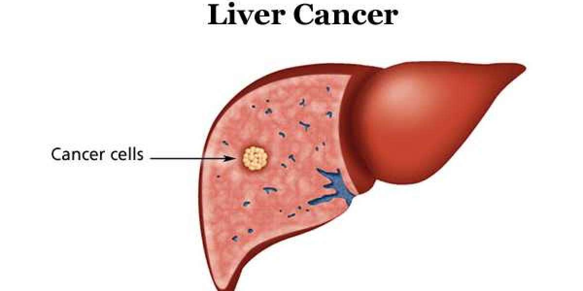 Understanding Liver Cancer: Can Treatment Cure 50% Liver Damage?