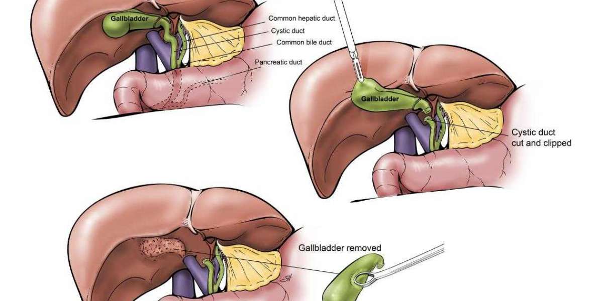 Best Gallbladder Removal Surgery in Delhi by Dr. Tarun Mittal