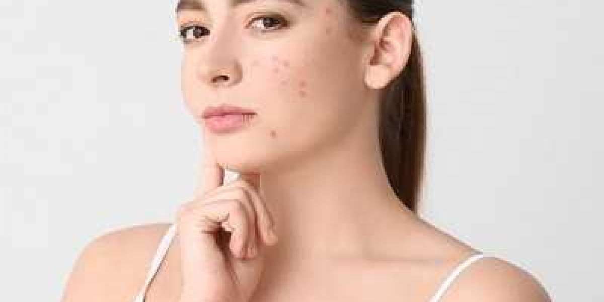 Advanced Acne Scar Therapy Options