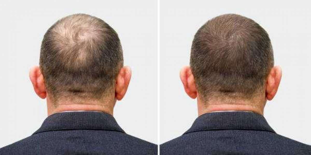 Factors Affecting FUE Hair Transplant Results