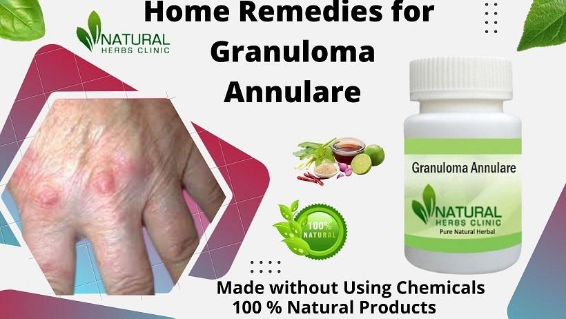 Granuloma Annulare is Treated with Common Vitamins and Supplements - Mashable Post