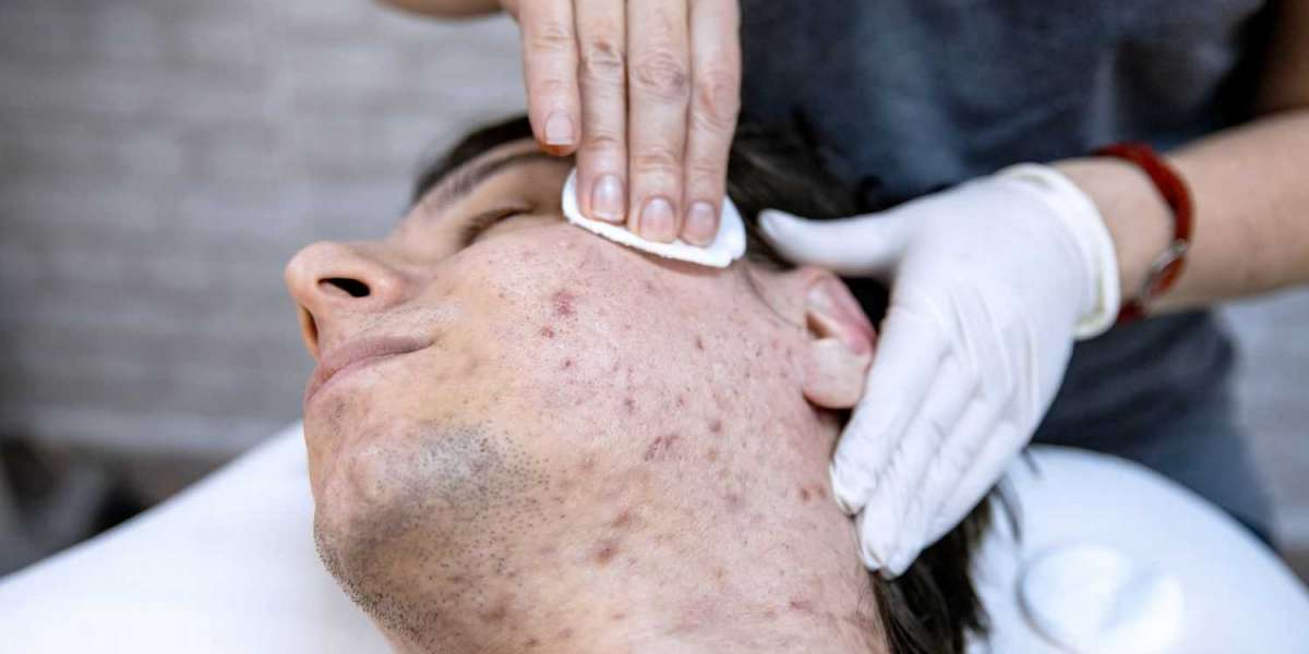 Acne Treatment Market Size, Future Trends and Innovation Report 2033