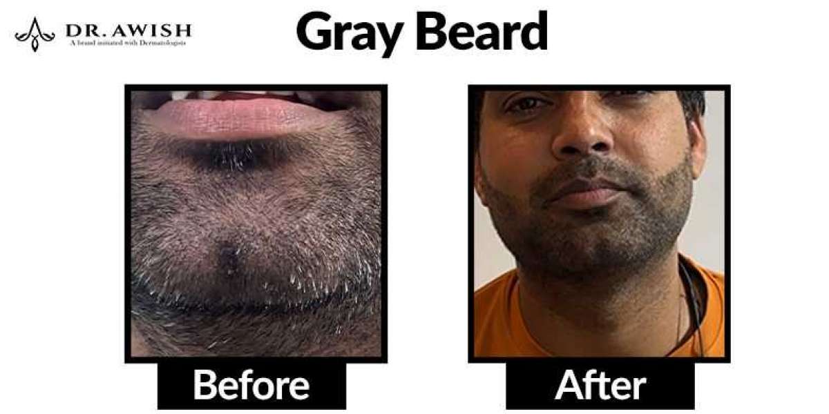 Gray Beard Solutions Natural and Cosmetic Options to Restore Color